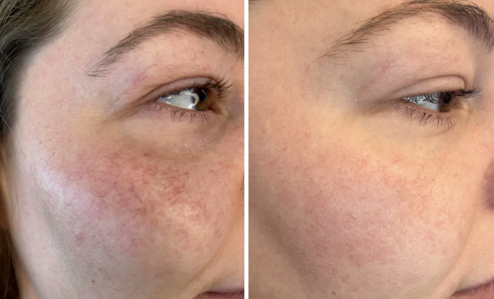 Fjernelse af karsprængninger i ansigtet