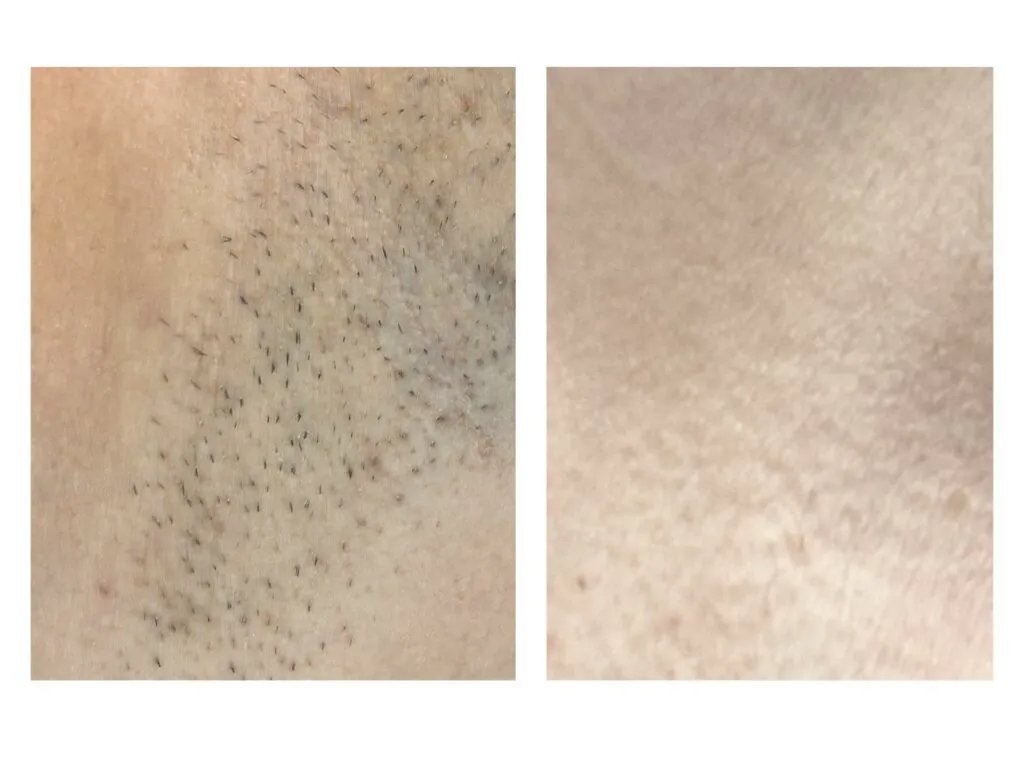 Permanent hårfjerning resultat