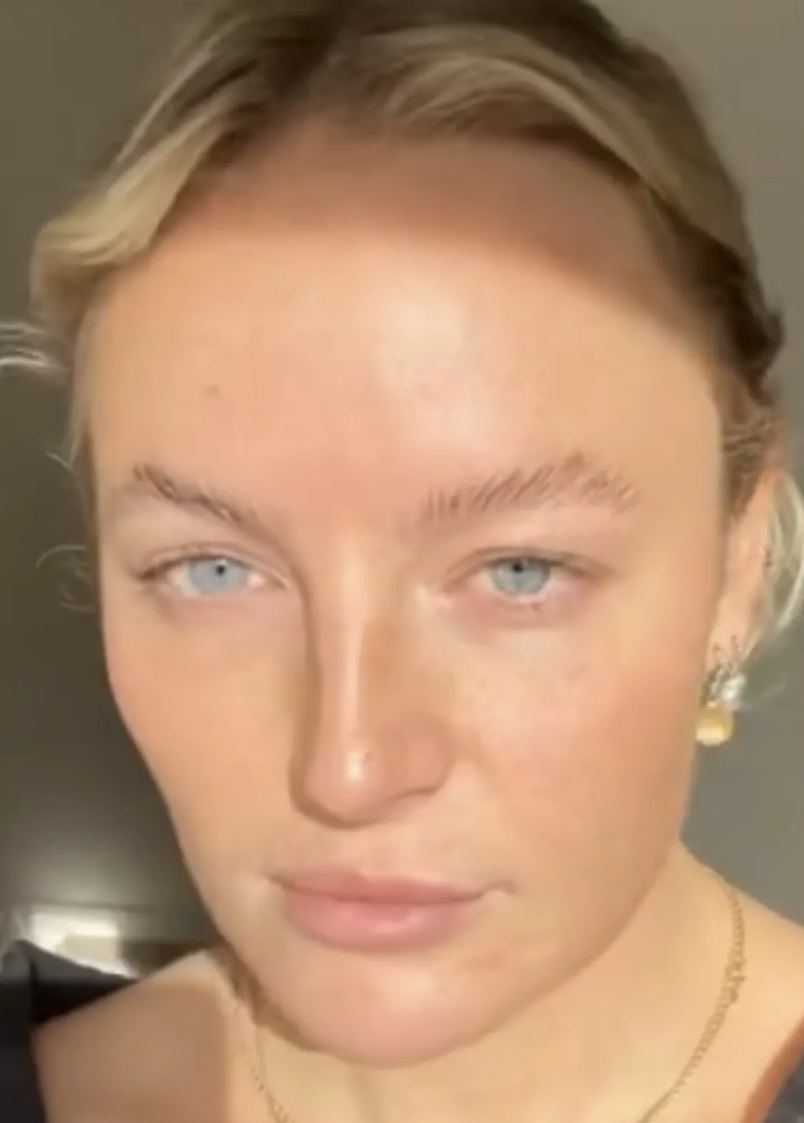 Efter (3 dage efter 1. beh.)