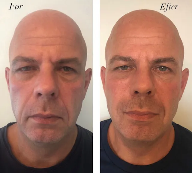 Ann-Sigts behandlinger, specielt for mænd